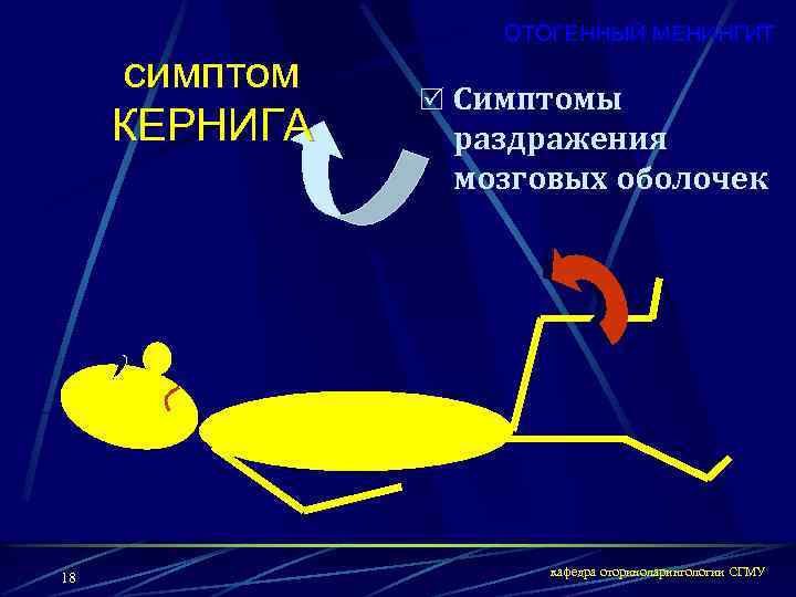 ОТОГЕННЫЙ МЕНИНГИТ симптом КЕРНИГА 18 R Симптомы раздражения мозговых оболочек кафедра оториноларингологии СГМУ 