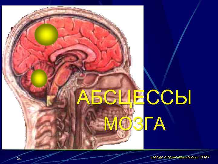 АБСЦЕССЫ МОЗГА 24 кафедра оториноларингологии СГМУ 