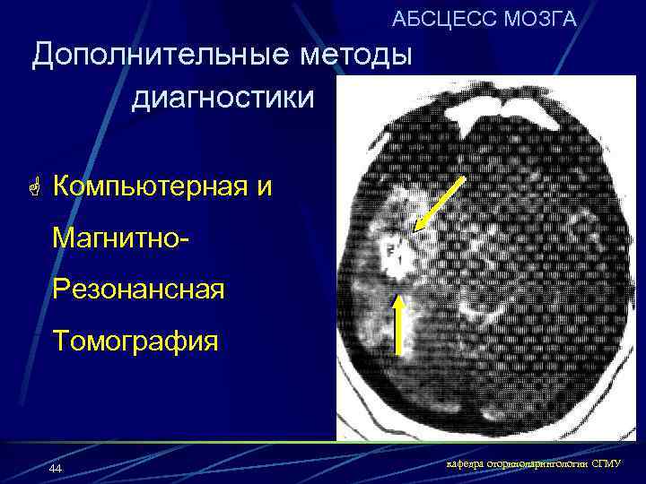 АБСЦЕСС МОЗГА Дополнительные методы диагностики G Компьютерная и Магнитно. Резонансная Томография 44 кафедра оториноларингологии