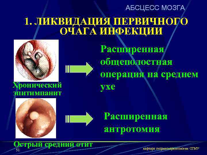 АБСЦЕСС МОЗГА 1. ЛИКВИДАЦИЯ ПЕРВИЧНОГО ОЧАГА ИНФЕКЦИИ Хронический эпитимпанит Расширенная общеполостная операция на среднем