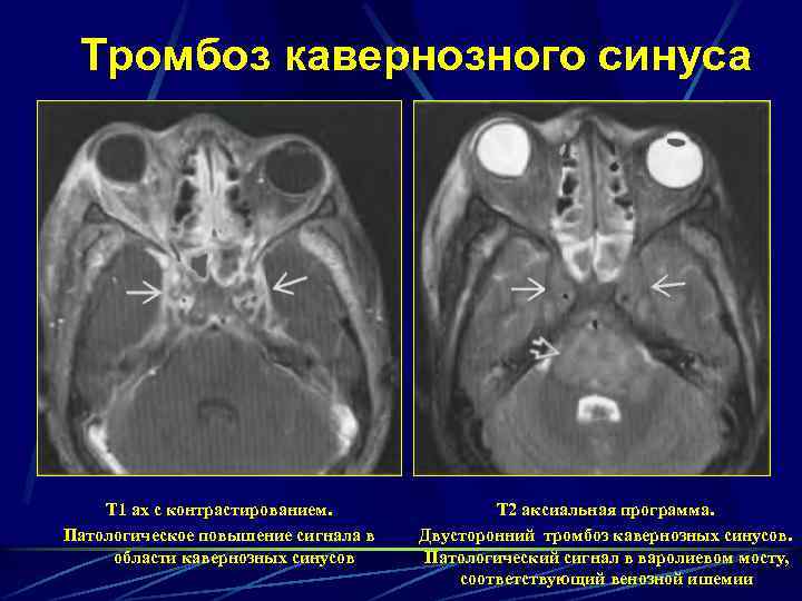 Тромбоз кавернозного синуса Т 1 ах с контрастированием. Патологическое повышение сигнала в области кавернозных