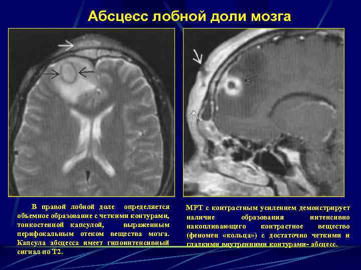 Абсцесс лобной доли мозга В правой лобной доле определяется объемное образование с четкими контурами,