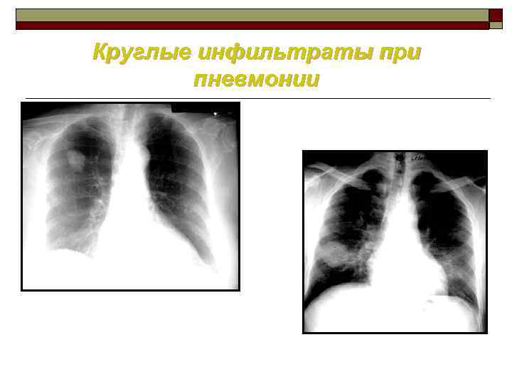 Круглые инфильтраты при пневмонии 
