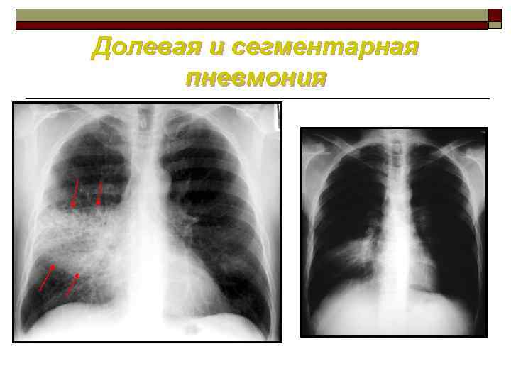 Сегментарная пневмония у детей что это