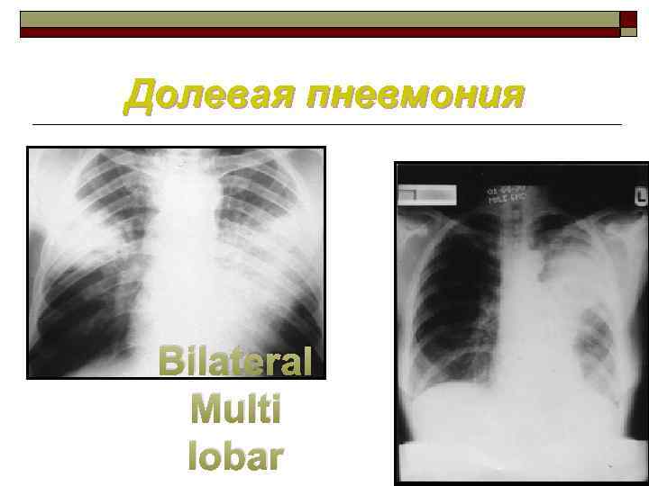 Долевая пневмония Bilateral Multi lobar 