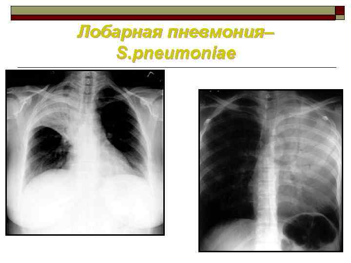 Пневмония s3