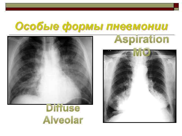 Особые формы пневмонии Aspiration MO Diffuse Alveolar 