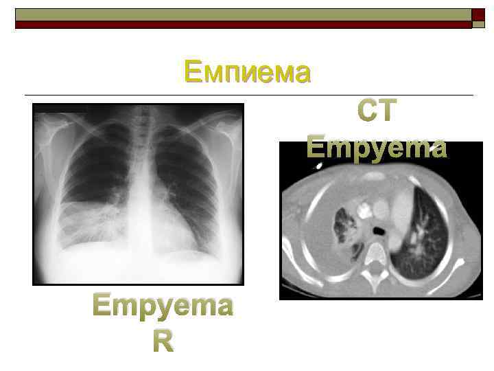 Емпиема CT Empyema R 