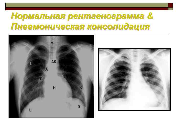 Нормальная рентгенограмма & Пневмоническая консолидация 