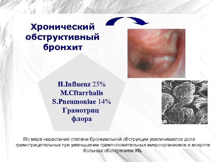 Хронический обструктивный бронхит H. Influenz 25% M. Cftarrhalis S. Pneumoniae 14% Грамотриц флора По