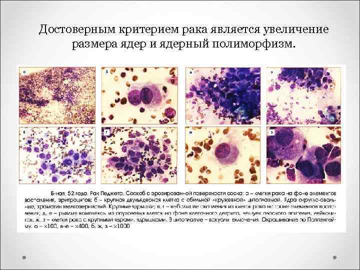 Клетки с гиперхромными ядрами. Клетки Педжета цитология. Ядерный полиморфизм клеток что это. Умеренная атипия клеток что. Полиморфизм опухолевых клеток.