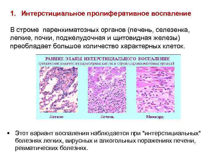 1. Интерстициальное пролиферативное воспаление В строме паренхиматозных органов (печень, селезенка, легкие, почки, поджелудочная и