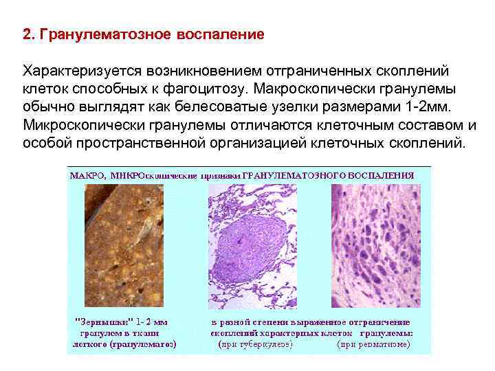 2. Гранулематозное воспаление Характеризуется возникновением отграниченных скоплений клеток способных к фагоцитозу. Макроскопически гранулемы обычно