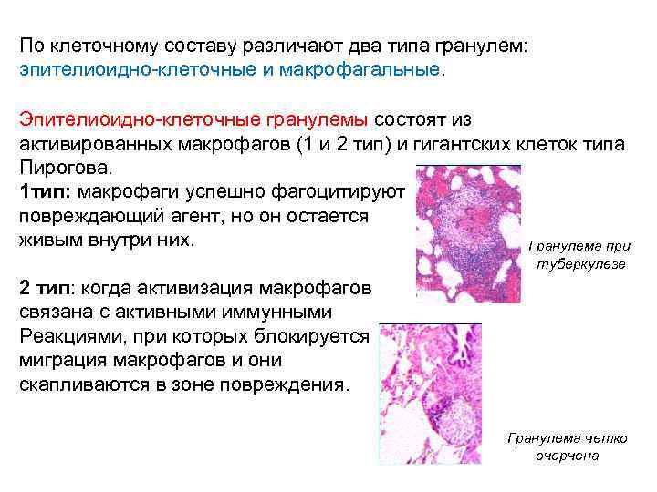 По клеточному составу различают два типа гранулем: эпителиоидно-клеточные и макрофагальные. Эпителиоидно-клеточные гранулемы состоят из