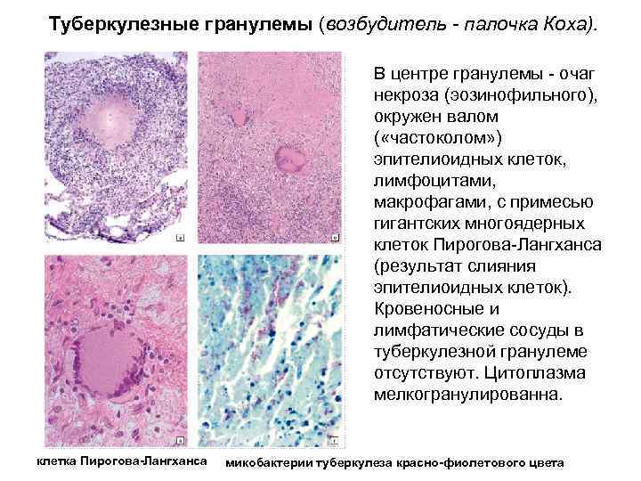 Туберкулезные гранулемы (возбудитель - палочка Коха). В центре гранулемы - очаг некроза (эозинофильного), окружен