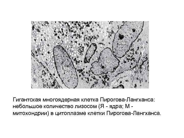 Гигантская многоядерная клетка Пирогова-Лангханса: небольшое количество лизосом (Я - ядра; М - митохондрии) в