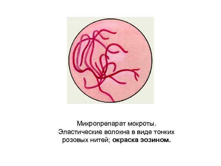 Микропрепарат мокроты. Эластические волокна в виде тонких розовых нитей; окраска эозином. 