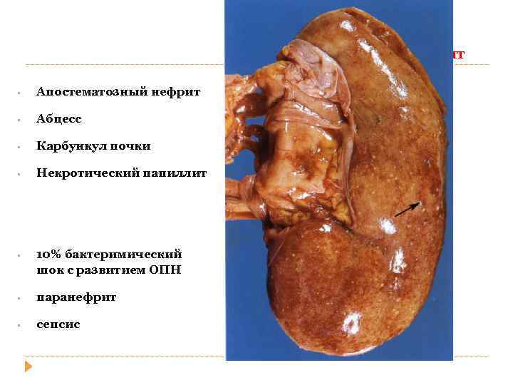 Острый пиелонефрит • Апостематозный нефрит • Абцесс • Карбункул почки • Некротический папиллит •