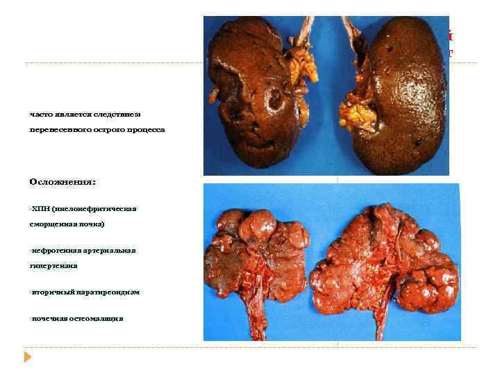 Хронический пиелонефрит часто является следствием перенесенного острого процесса Осложнения: • ХПН (пиелонефритическая сморщенная почка)