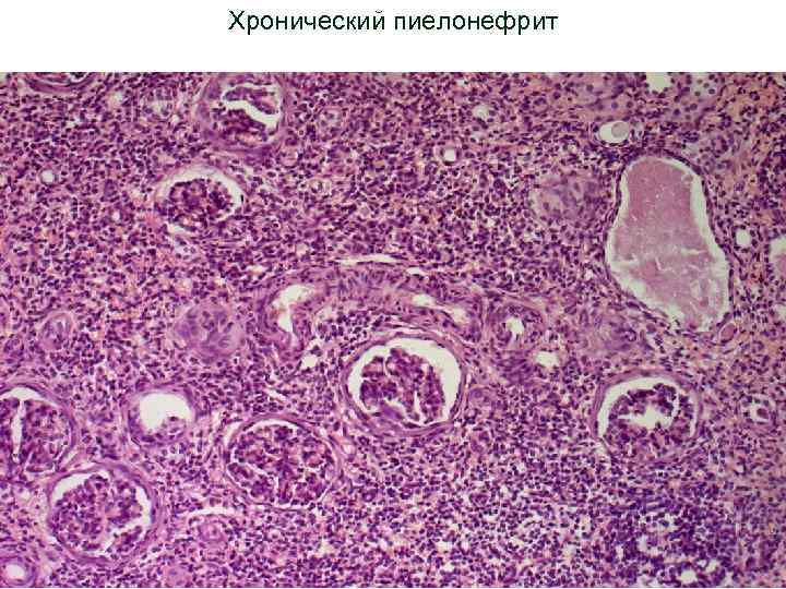 Хронический пиелонефрит 