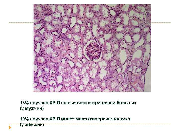 13% случаев ХР. П не выявляют при жизни больных (у мужчин) 10% случаев ХР.