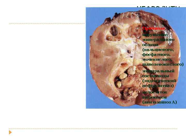 НЕФРОЛИТИ АЗ Причины: • нарушение минерального обмена (кальциевого, фосфатного, мочекислого, щавелевокислого) • миниральный состав