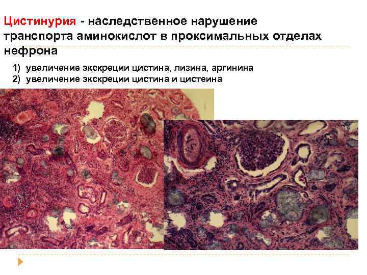 Цистинурия - наследственное нарушение транспорта аминокислот в проксимальных отделах нефрона 1) увеличение экскреции цистина,