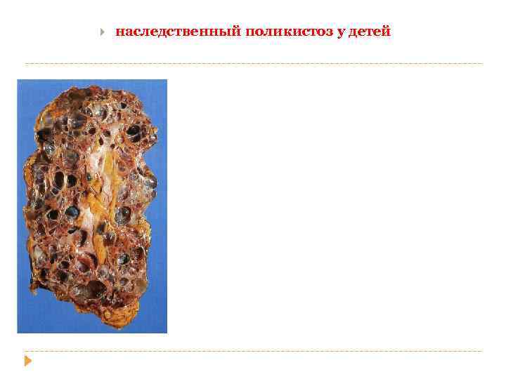  наследственный поликистоз у детей 