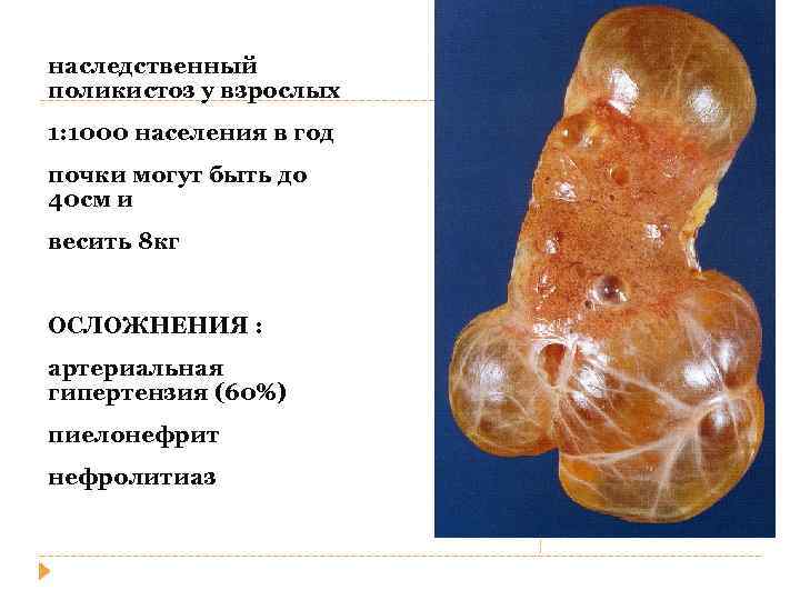 наследственный поликистоз у взрослых 1: 1000 населения в год почки могут быть до 40