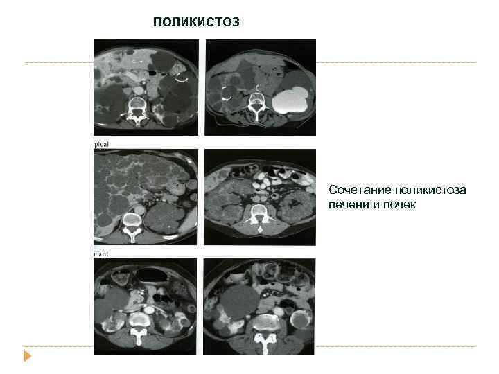 ПОЛИКИСТОЗ Сочетание поликистоза печени и почек 