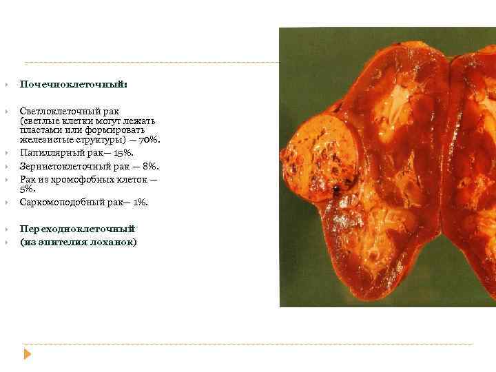 РАК ПОЧКИ Почечноклеточный: Светлоклеточный рак (светлые клетки могут лежать пластами или формировать железистые структуры)