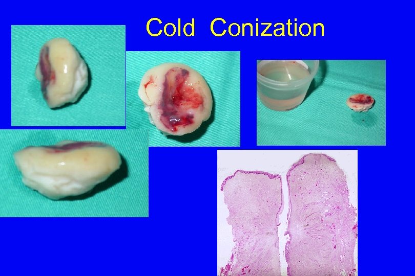 Cold Conization 