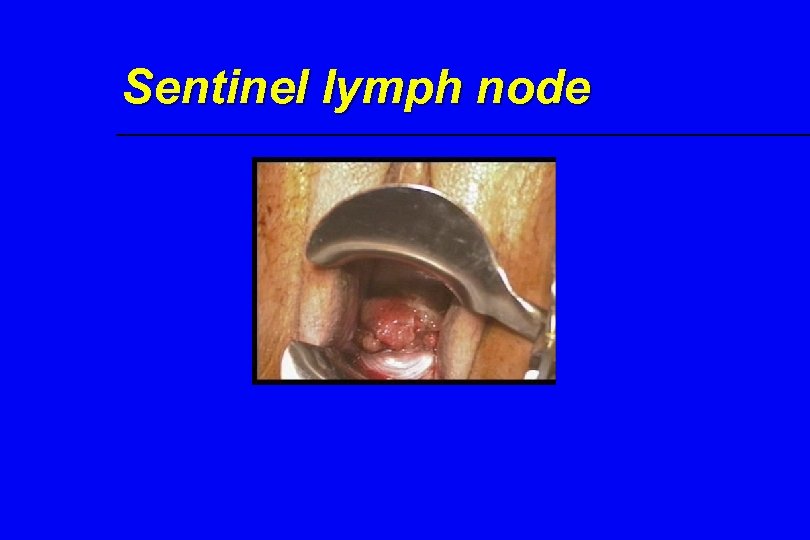 Sentinel lymph node 