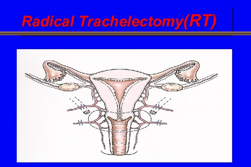 Radical Trachelectomy(RT) 