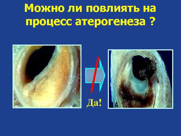 Можно ли повлиять на процесс атерогенеза ? Да! 