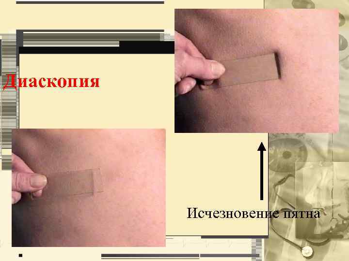 Диаскопия Исчезновение пятна 