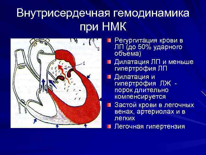 Внутрисердечная гемодинамика при НМК Регургитация крови в ЛП (до 50% ударного объема) Дилатация ЛП