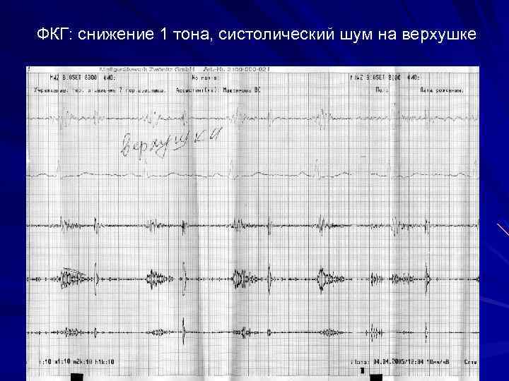 ФКГ: снижение 1 тона, систолический шум на верхушке 