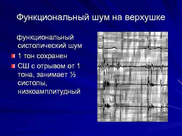 Функциональный шум на верхушке функциональный систолический шум 1 тон сохранен СШ с отрывом от