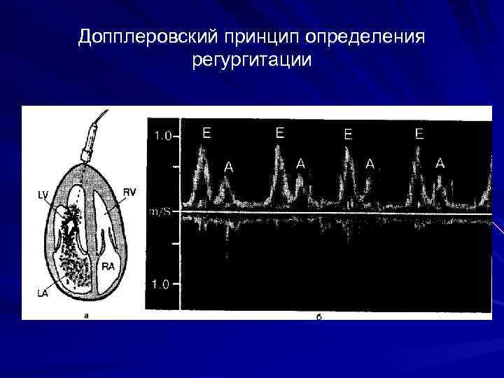 Допплеровский принцип определения регургитации 