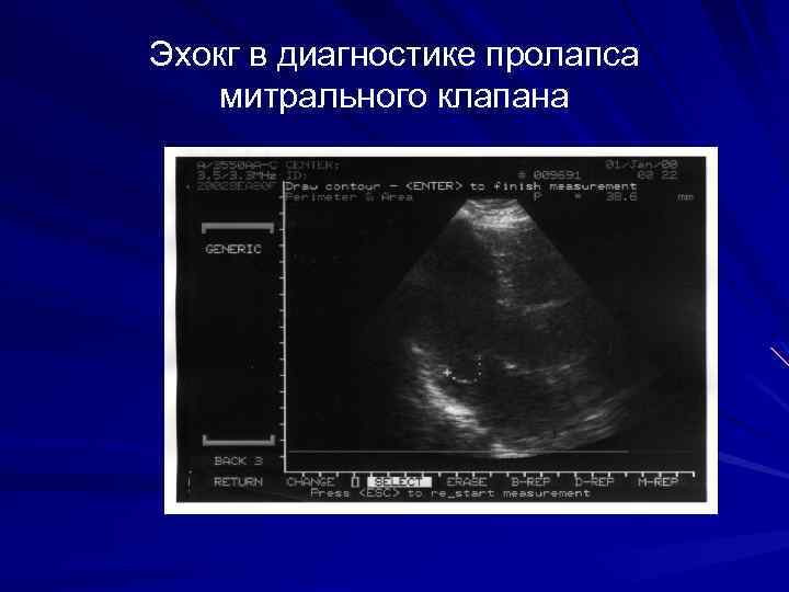 Эхокг в диагностике пролапса митрального клапана 