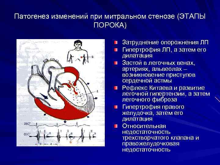Патогенез изменений при митральном стенозе (ЭТАПЫ ПОРОКА) Затруднение опорожнения ЛП Гипертрофия ЛП, а затем