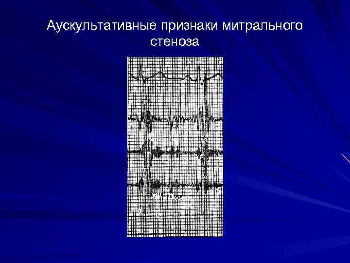 Аускультативные признаки митрального стеноза 