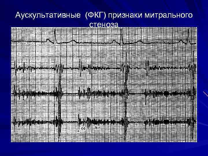 Аускультативные (ФКГ) признаки митрального стеноза 