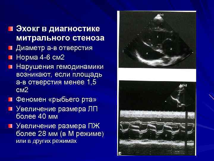 Эхокг в диагностике митрального стеноза Диаметр а-в отверстия Норма 4 -6 см 2 Нарушения