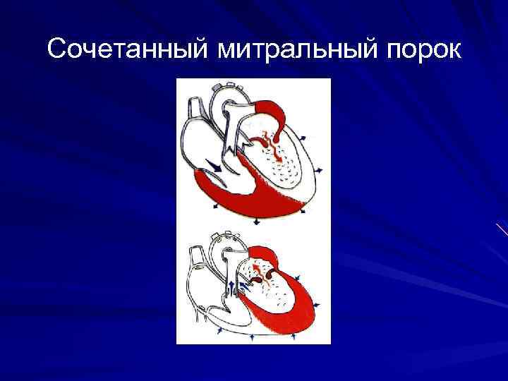 Сочетанный митральный порок 