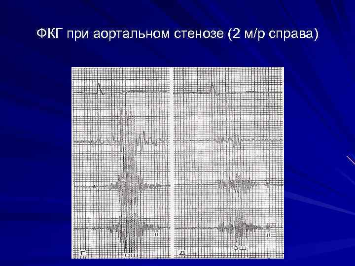ФКГ при аортальном стенозе (2 м/р справа) 