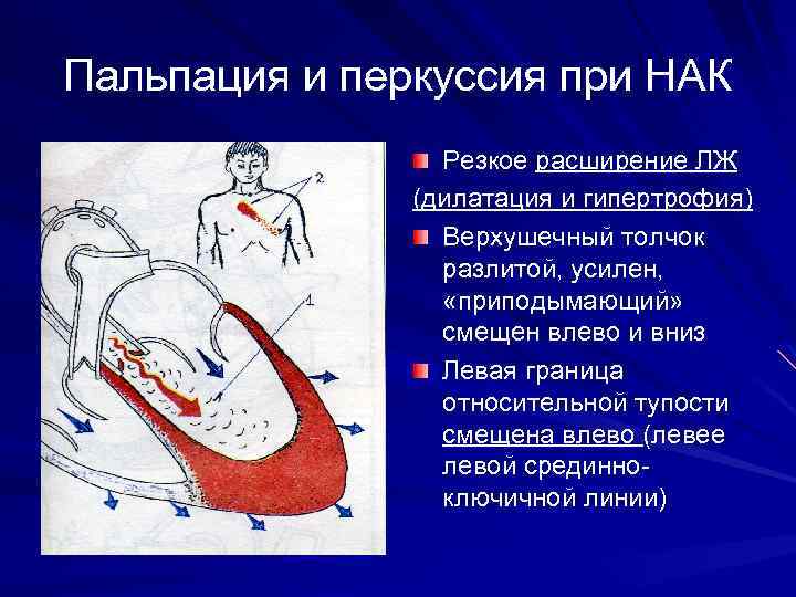 Пальпация и перкуссия при НАК Резкое расширение ЛЖ (дилатация и гипертрофия) Верхушечный толчок разлитой,