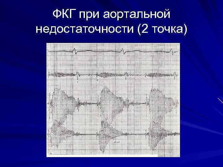 ФКГ при аортальной недостаточности (2 точка) 