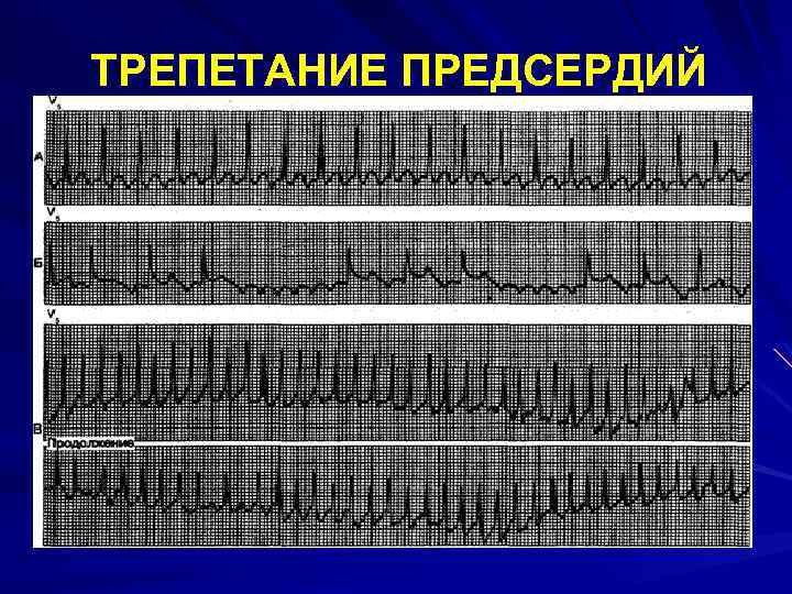 ТРЕПЕТАНИЕ ПРЕДСЕРДИЙ 